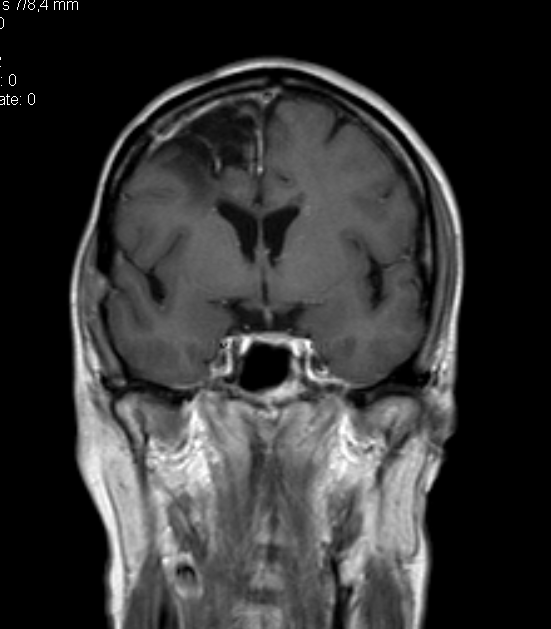 MRI van achteren, 21-06-2013